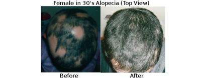 female30salopeciatop