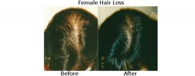 femalehairloss