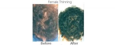 femalethinning2