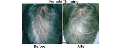 femalethinning4