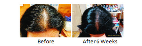 Female 34 years old Natural Hair Regrowth Treatment, before and after 6 weeks.